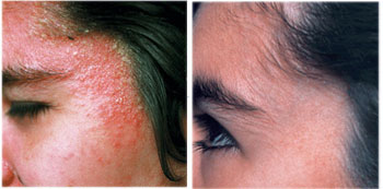 Mary Dolson Eczema Before & After