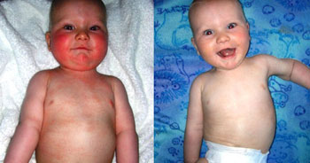 Baby Garret Eczema Before & After